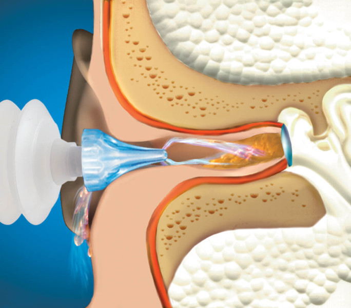 ProRinse® Earwax Removal System - Mack's Ear Plugs